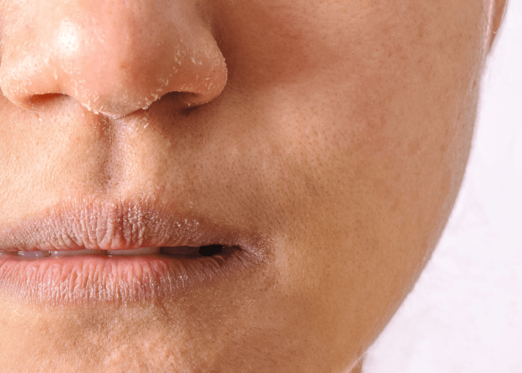 Mengatasi Kulit Kering