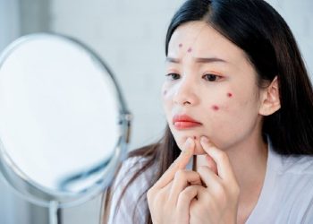 menghilangkan jerawat