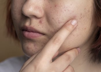 acne prone skin