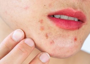 acne skin eksfoliasi