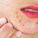 acne skin eksfoliasi