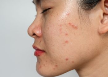 Kulit Berjerawat Wanita