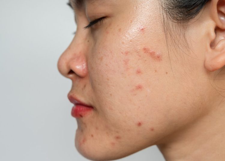 Kulit Berjerawat Wanita
