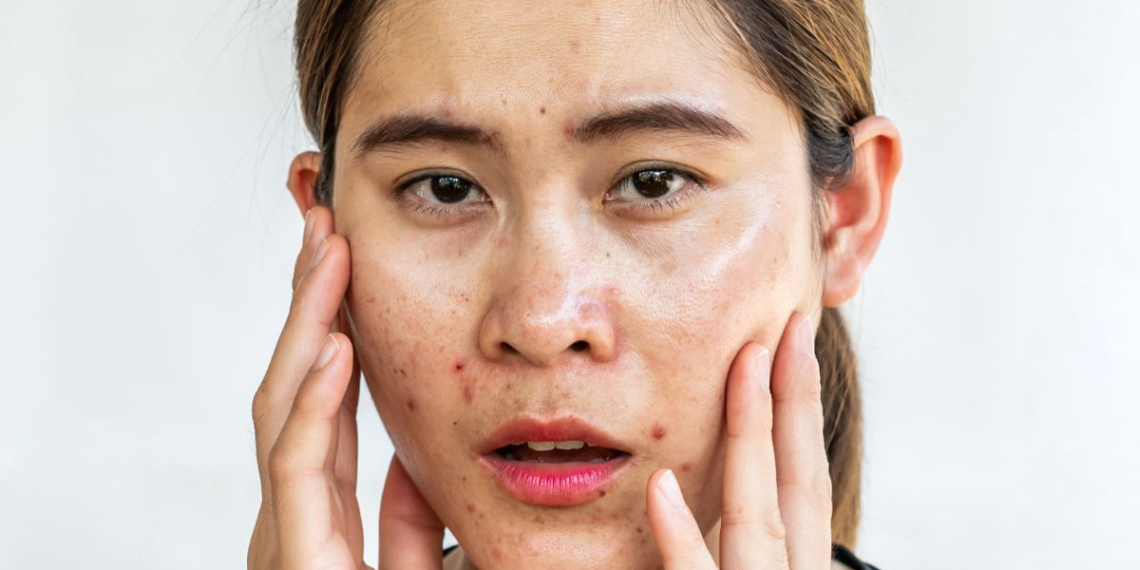 Sunscreen Kulit Berjerawat