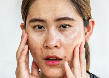 Sunscreen Kulit Berjerawat