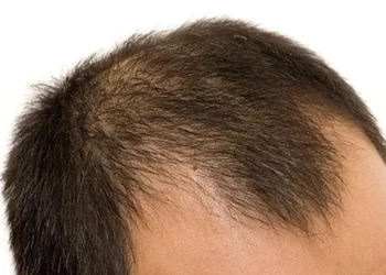 rambut rontok pada pria