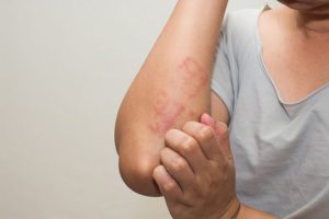 kulit eczema