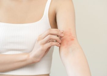 Punya Kulit Eczema Bikin Kamu Jadi Insecure?! Ini Dia Produk yang Aman Banget untuk Meredakan Eczema Kamu!