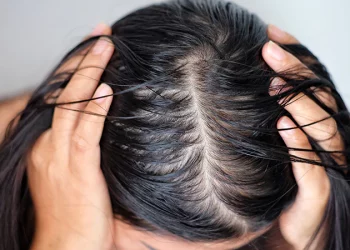 rambut berminyak dan lepek