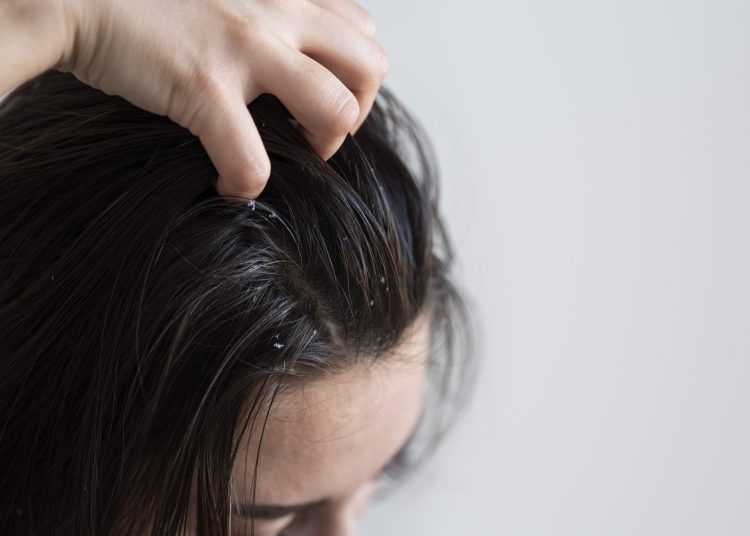 rambut lepek dan berminyak