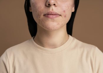 sunscreen wajah bejerawat