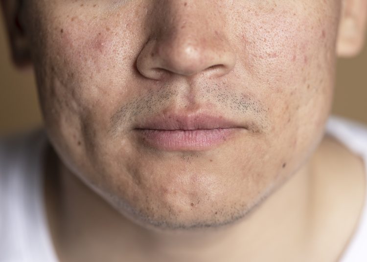 Tips Bersihkan Wajah untuk Kulit Berjerawat & Berminyak Untuk Pria!