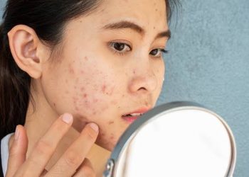 kulit berminyak dan berjerawat