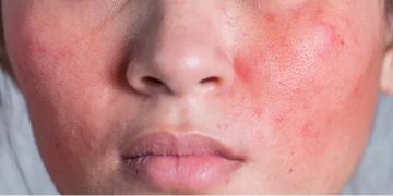 Kulit Sensitif Takut Eksfoliasi? Coba Kenali PHA!