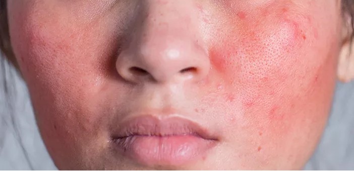 Kulit Sensitif Takut Eksfoliasi? Coba Kenali PHA!