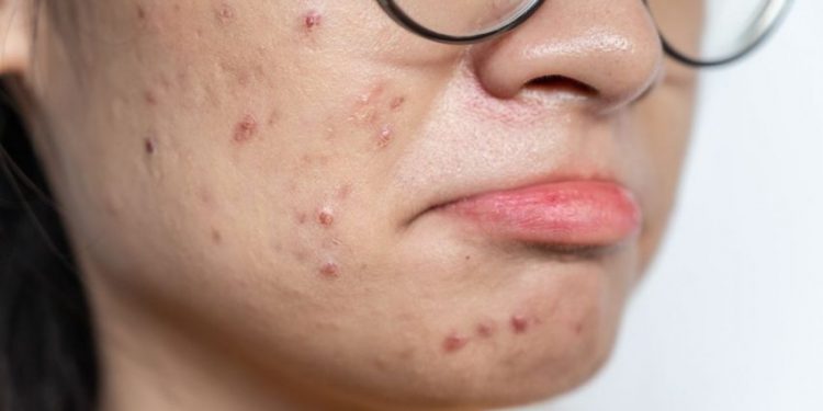 Stop Dipencet! Begini Cara Bantu Jerawat Cepat Mereda