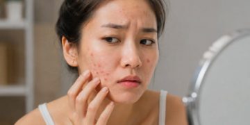 Traveling Bikin Kulit Mudah Breakout? Ini yang Perlu Diperhatikan!