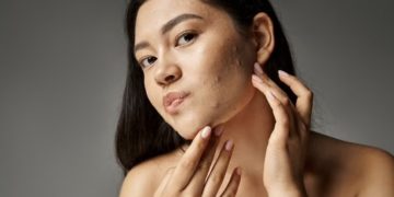 Kulit Acne-Prone Tetap Butuh Sunscreen, Justru Setiap Hari!