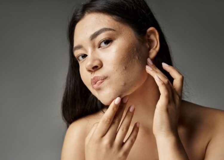 Kulit Acne-Prone Tetap Butuh Sunscreen, Justru Setiap Hari!