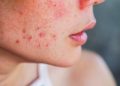 Kulit Gampang Merah dan Terasa Kering? Mungkin Saatnya Balik ke Skincare yang Gentle!