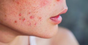 Kulit Gampang Merah dan Terasa Kering? Mungkin Saatnya Balik ke Skincare yang Gentle!