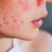 Kulit Gampang Merah dan Terasa Kering? Mungkin Saatnya Balik ke Skincare yang Gentle!