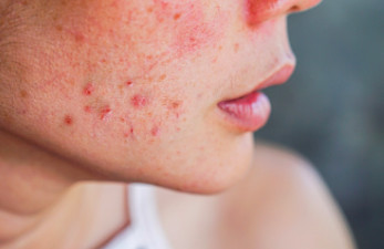 Kulit Gampang Merah dan Terasa Kering? Mungkin Saatnya Balik ke Skincare yang Gentle!