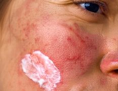 Udah Tahu Sunscreen Penting, Tapi Kulit Sensitif Sering Bikin Kamu Ragu Memakainya? Ketahui Hal Ini!