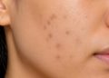 Pakai Makeup Makin Tebal Buat Nutupin Dark Spot? Mungkin Ini Saatnya Fokus untuk Samarkan!