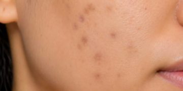 Pakai Makeup Makin Tebal Buat Nutupin Dark Spot? Mungkin Ini Saatnya Fokus untuk Samarkan!