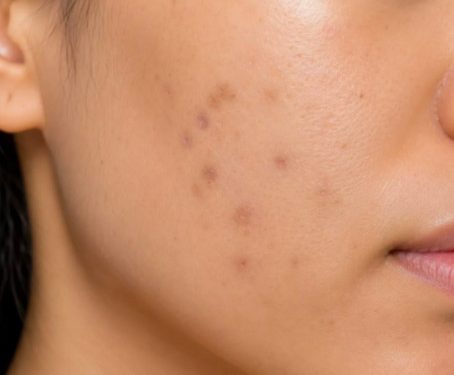 Pakai Makeup Makin Tebal Buat Nutupin Dark Spot? Mungkin Ini Saatnya Fokus untuk Samarkan!