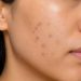 Pakai Makeup Makin Tebal Buat Nutupin Dark Spot? Mungkin Ini Saatnya Fokus untuk Samarkan!