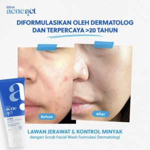 rutinitas cuci muka untuk kulit acne-prone