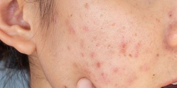 Bekas Jerawat Nggak Kunjung Pudar? Kenali Ingredients untuk Membantu Menyamarkannya!