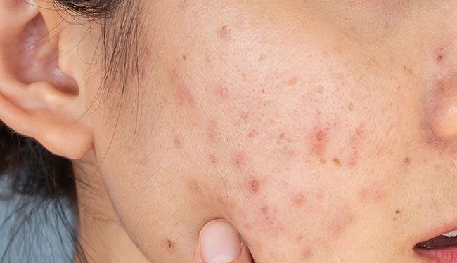 Bekas Jerawat Nggak Kunjung Pudar? Kenali Ingredients untuk Membantu Menyamarkannya!