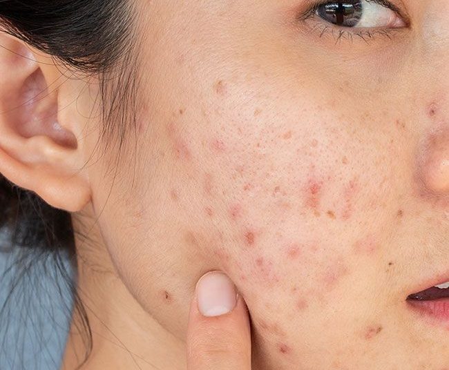 Bekas Jerawat Nggak Kunjung Pudar? Kenali Ingredients untuk Membantu Menyamarkannya!