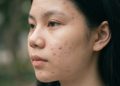 Acne-Prone tapi Kulit Sensitif? Ini Cara Merawat Keduanya Tanpa Bikin Kulit Makin Rewel!