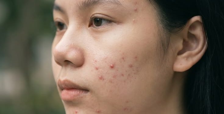 Acne-Prone tapi Kulit Sensitif? Ini Cara Merawat Keduanya Tanpa Bikin Kulit Makin Rewel!