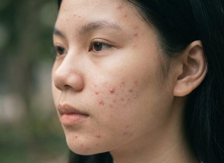 Acne-Prone tapi Kulit Sensitif? Ini Cara Merawat Keduanya Tanpa Bikin Kulit Makin Rewel!