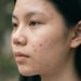 Acne-Prone tapi Kulit Sensitif? Ini Cara Merawat Keduanya Tanpa Bikin Kulit Makin Rewel!