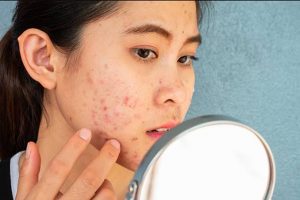sunscreen untuk kulit berjerawat