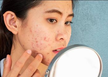 Punya Kulit Gampang Jerawatan, Kenapa Pilih Sunscreen Jadi Serba Salah?