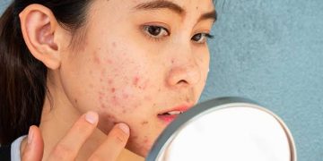 Punya Kulit Gampang Jerawatan, Kenapa Pilih Sunscreen Jadi Serba Salah?
