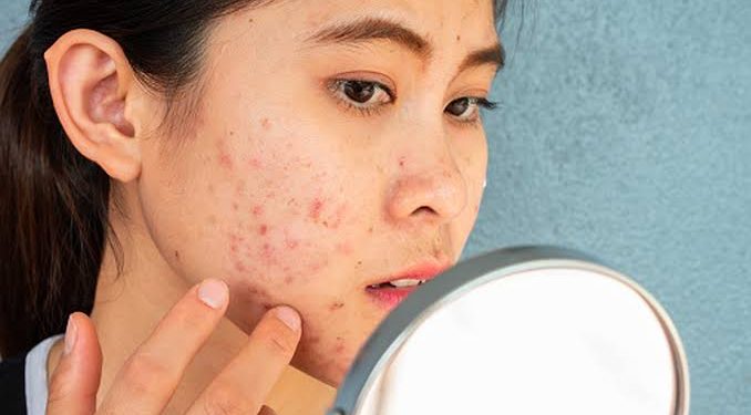 Punya Kulit Gampang Jerawatan, Kenapa Pilih Sunscreen Jadi Serba Salah?