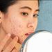 Punya Kulit Gampang Jerawatan, Kenapa Pilih Sunscreen Jadi Serba Salah?