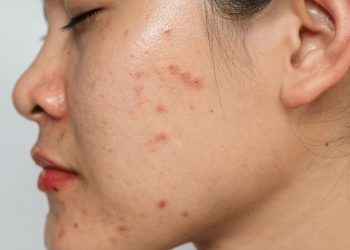 Acne-Prone dan Sensitive Skin dalam Satu Wajah? Ini 3 Cara Utama untuk Merawatnya!