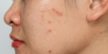 Acne-Prone dan Sensitive Skin dalam Satu Wajah? Ini 3 Cara Utama untuk Merawatnya!