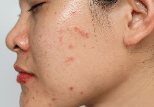 Acne-Prone dan Sensitive Skin dalam Satu Wajah? Ini 3 Cara Utama untuk Merawatnya!