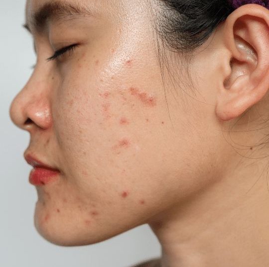 Acne-Prone dan Sensitive Skin dalam Satu Wajah? Ini 3 Cara Utama untuk Merawatnya!