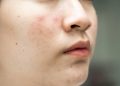 Kalau Jerawat dan Bekasnya Datang Bergantian, Apakah Rutinitas Skincare Harus Ikut Dibedakan?